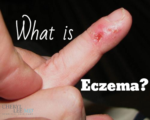 What Is Eczema