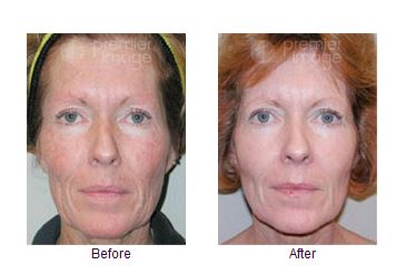 Get Rid Of Wrinkles and Blemishes Instantly With Chemical Peeling